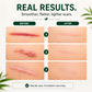 Gentle Silicone Scar Sheets