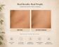 Gentle Silicone Scar Sheets
